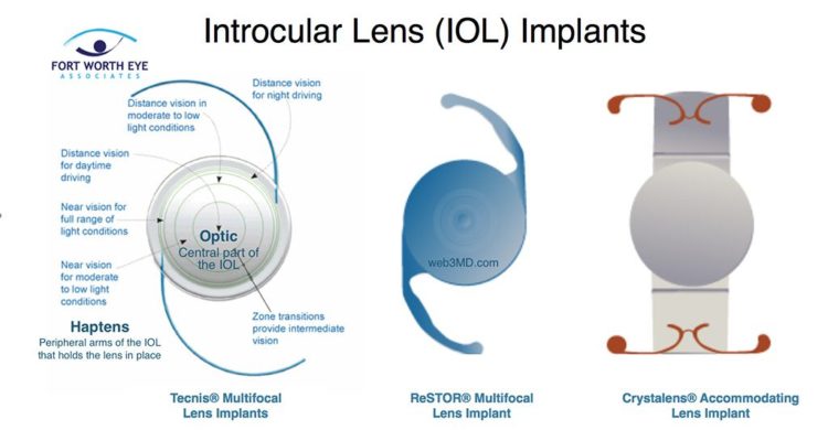 which-lens-is-best-for-cataract-surgery-big-photography-leading