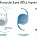 Which lens is best for cataract surgery?